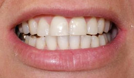 After treatment with In-Line Invisible Braces