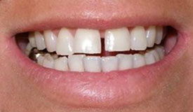 Before treatment with In-Line Invisible Braces