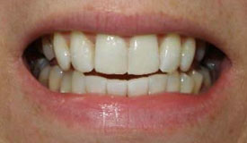 After treatment with In-Line Invisible Braces