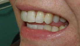 After treatment with In-Line Invisible Braces