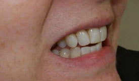 After treatment with In-Line Invisible Braces