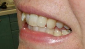 Before treatment with In-Line Invisible Braces