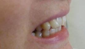 Before treatment with In-Line Invisible Braces