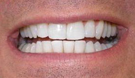 After treatment with In-Line Invisible Braces
