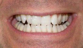 Before treatment with In-Line Invisible Braces