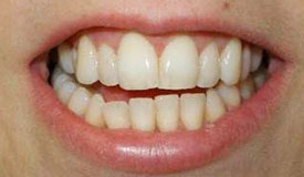 After treatment with In-Line Invisible Braces