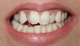 Before treatment with In-Line Invisible Braces