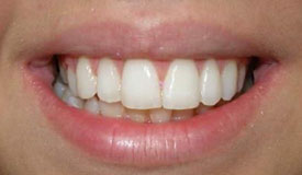 After treatment with In-Line Invisible Braces