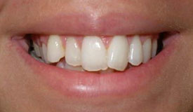 Before & After Photos – In-Line Invisible Braces