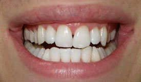 After treatment with In-Line Invisible Braces