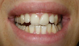 Before treatment with In-Line Invisible Braces