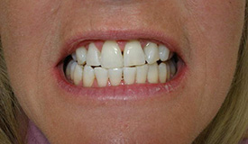 After treatment with In-Line Invisible Braces