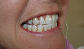 After treatment with In-Line Invisible Braces