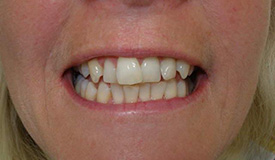Before treatment with In-Line Invisible Braces
