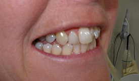 Before treatment with In-Line Invisible Braces