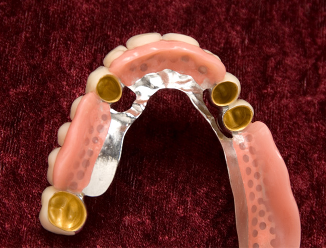 Telescopic Dentures – In-Line Invisible Braces